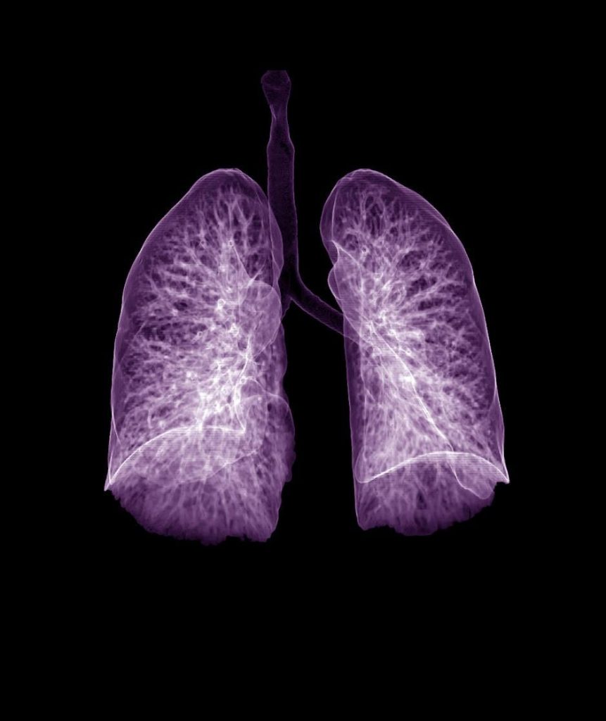 1 in 4 COVID survivors had impaired lung function 1 year on, study shows (By: Mary Van Beusekom, MS)