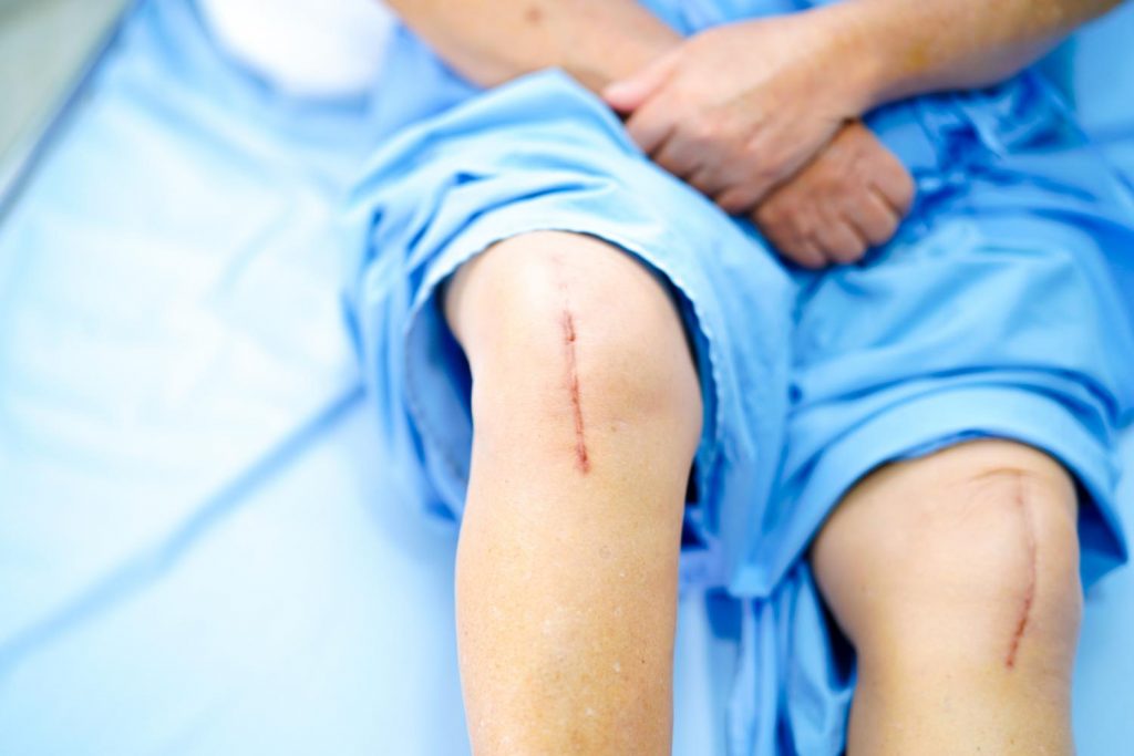 Trial finds additional antibiotics don’t protect against joint replacement infection (By: Chris Dall, MA)