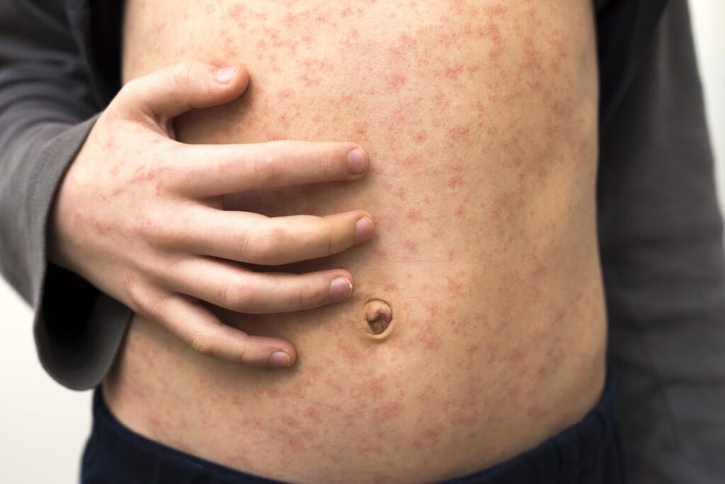 LA County reports first measles case of 2025—in LAX traveler—as cases confirmed in Philadelphia, NY state- Stephanie Soucheray, MA