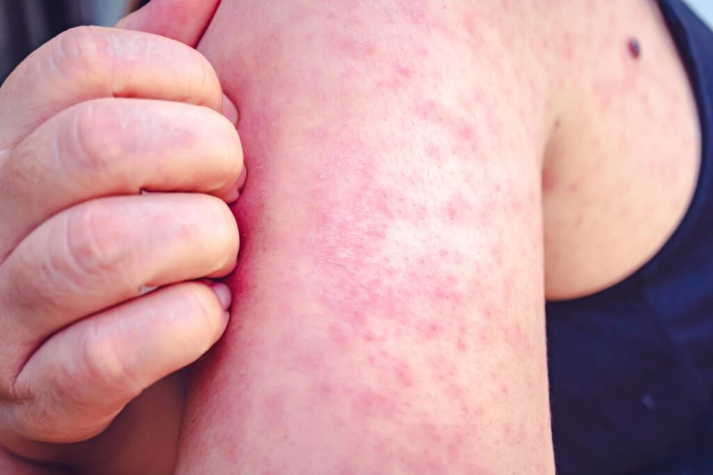 Oklahoma reports first measles cases linked to growing Texas outbreak -Stephanie Soucheray, MA