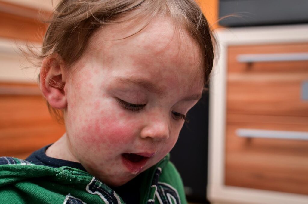 US measles cases approach 500 in worst year since 2019- Lisa Schnirring