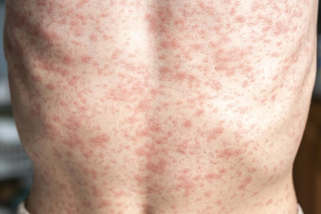 US measles total tops 600 cases, with almost 500 in Texas- Lisa Schnirring